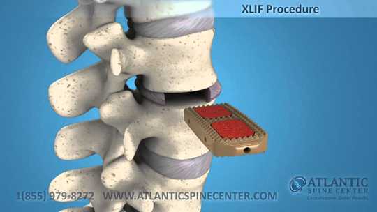 xlif-extreme-lateral-interbody-fusion-atlantic-spine-center