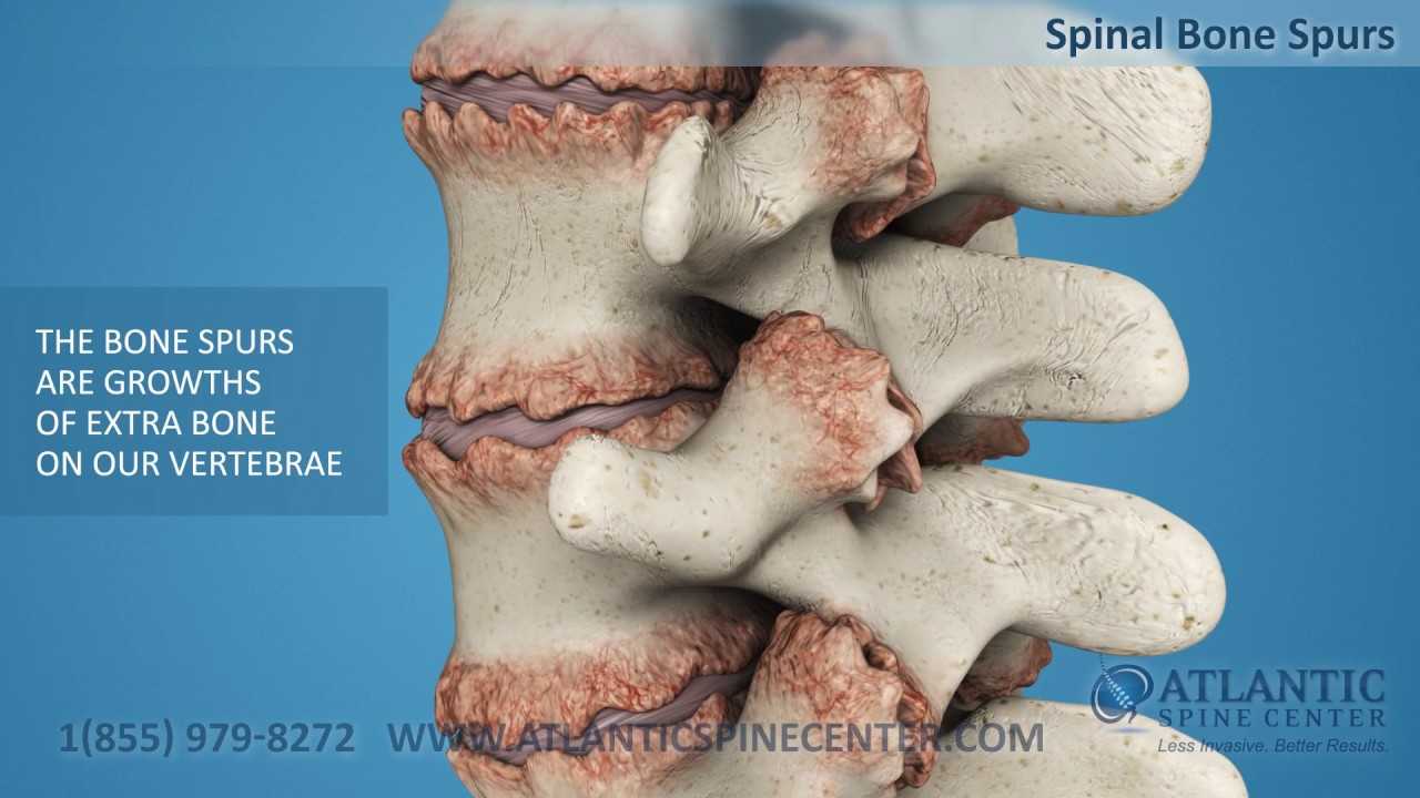 What Are Spinal Bone Spurs Atlantic Spine Center