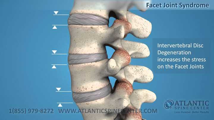 What Is Facet Joint Syndrome Atlantic Spine Center