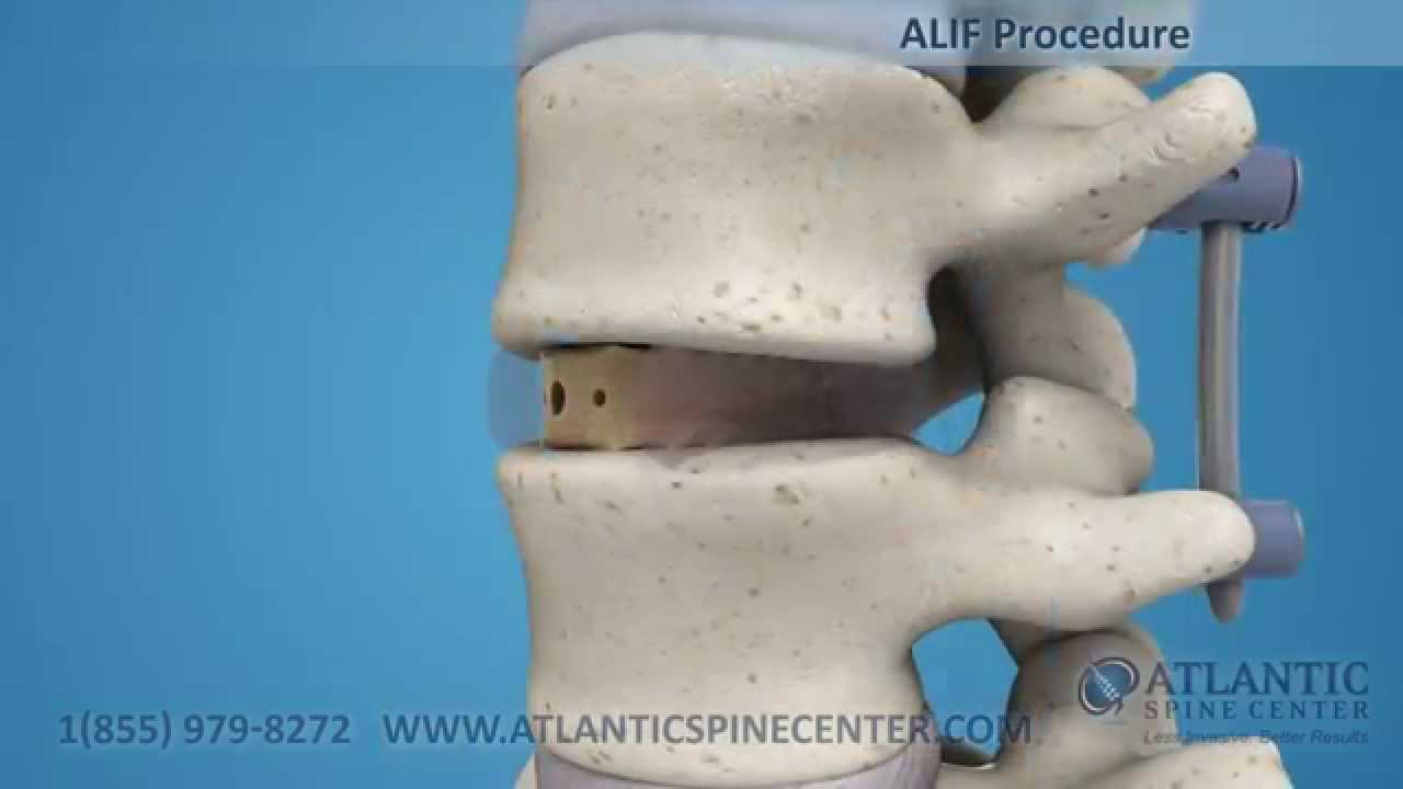 ALIF - Anterior Lumbar Interbody Fusion | Atlantic Spine Center