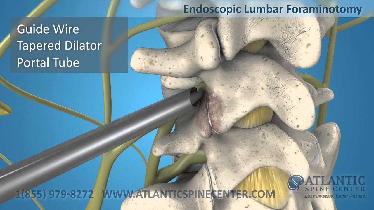Endoscopic Foraminotomy Of The Lumbar And Cervical Spine Atlantic Spine Center 