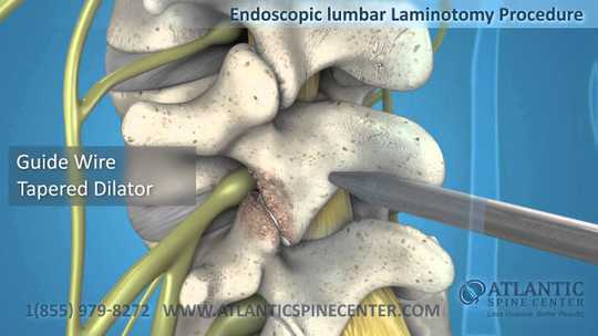 Endoscopic Lumbar Laminotomy | Atlantic Spine Center