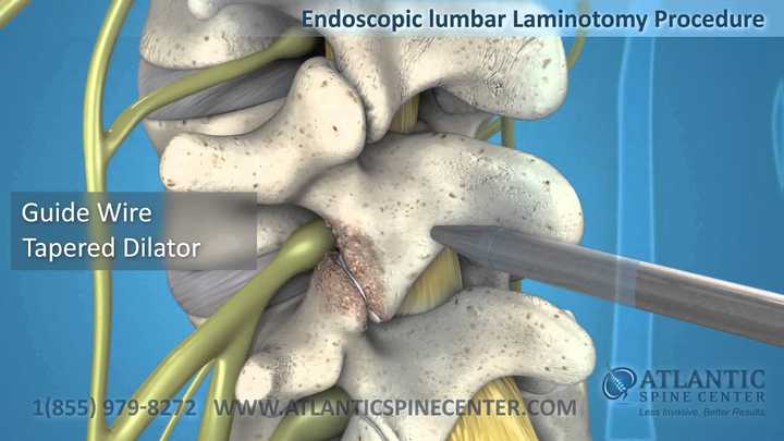 Endoscopic Lumbar Laminotomy Atlantic Spine Center