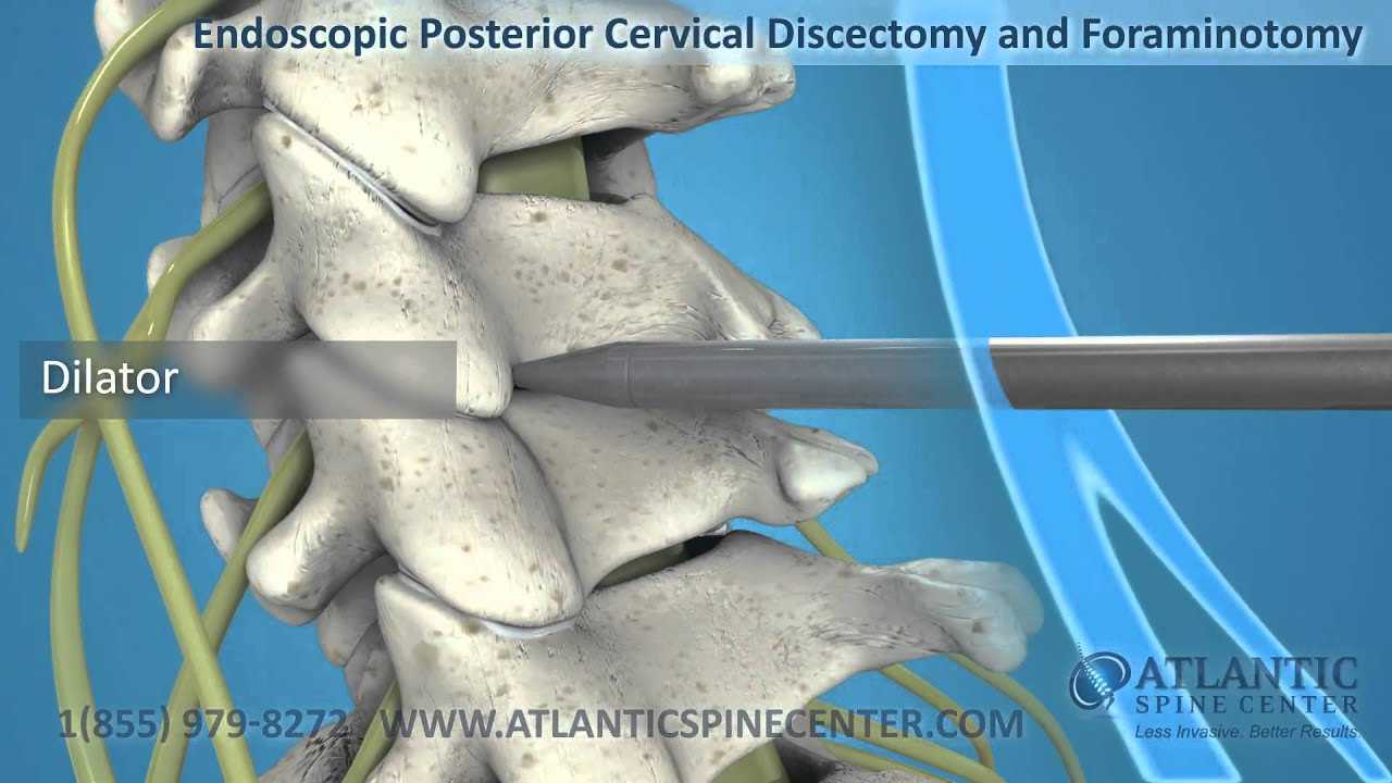 Endoscopic Foraminotomy of the Lumbar and Cervical Spine | Atlantic ...