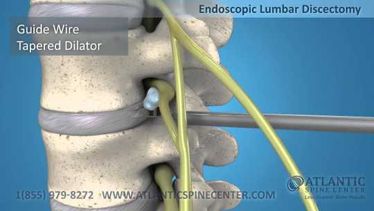 Endoscopic Discectomy of the Lumbar and Cervical Spine