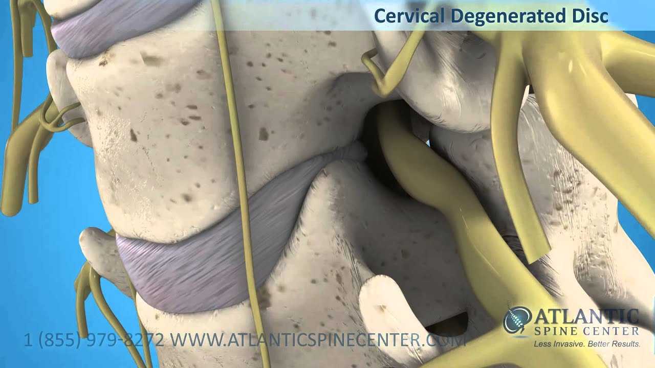 What is Degenerative Disc Disease? | Atlantic Spine Center