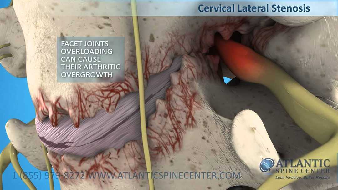https://www.atlanticspinecenter.com/static/ce838262a6cbf75518e5865f40b3af0a/10d63/cervical-stenosis.jpg
