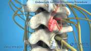 Endoscopic Facet Rhizotomy | Atlantic Spine Center