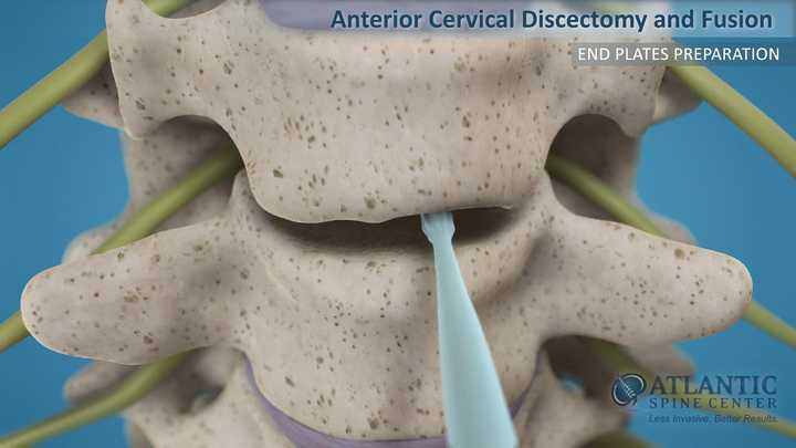 Anterior Cervical Discectomy and Fusion | Atlantic Spine Center